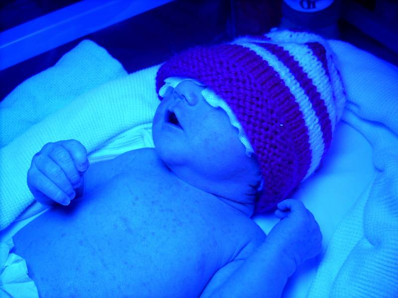 En la imagen, un neonato recibe fototerapia.
