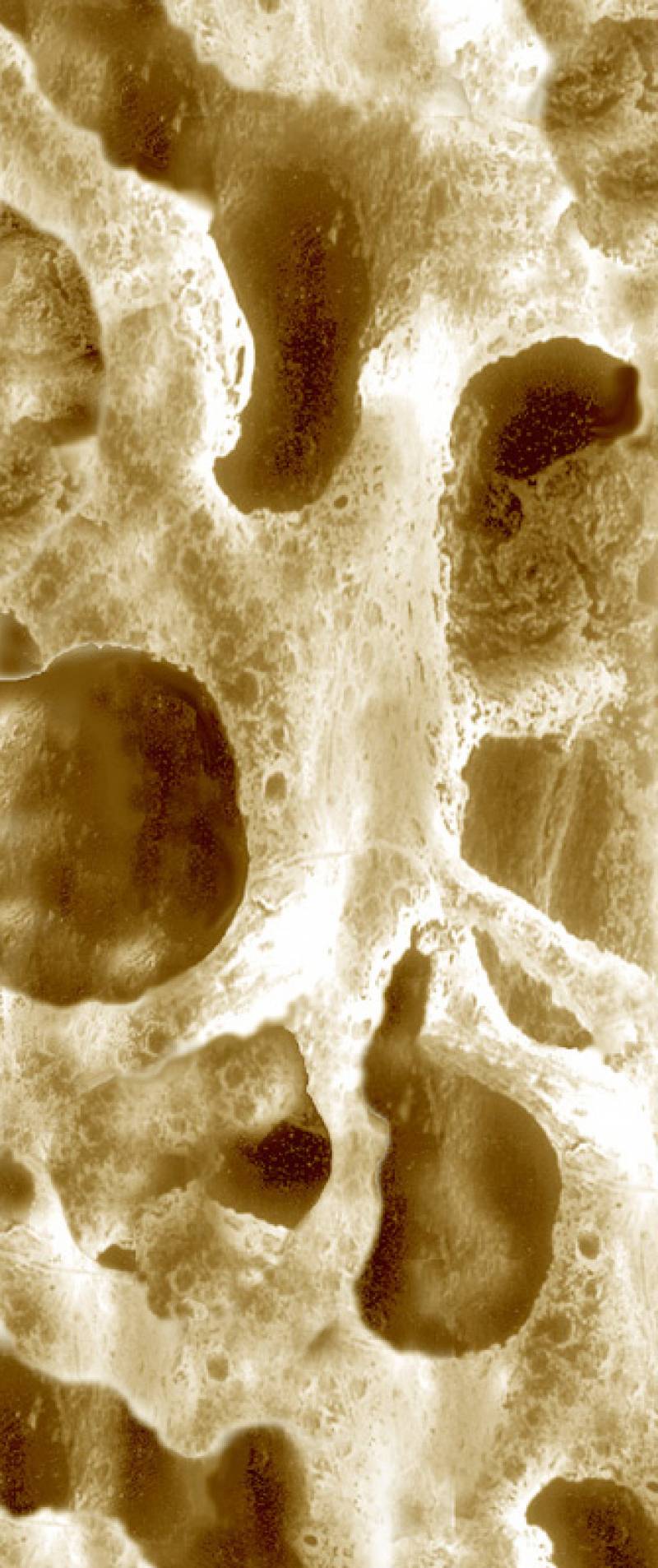 hueso osteoporosis