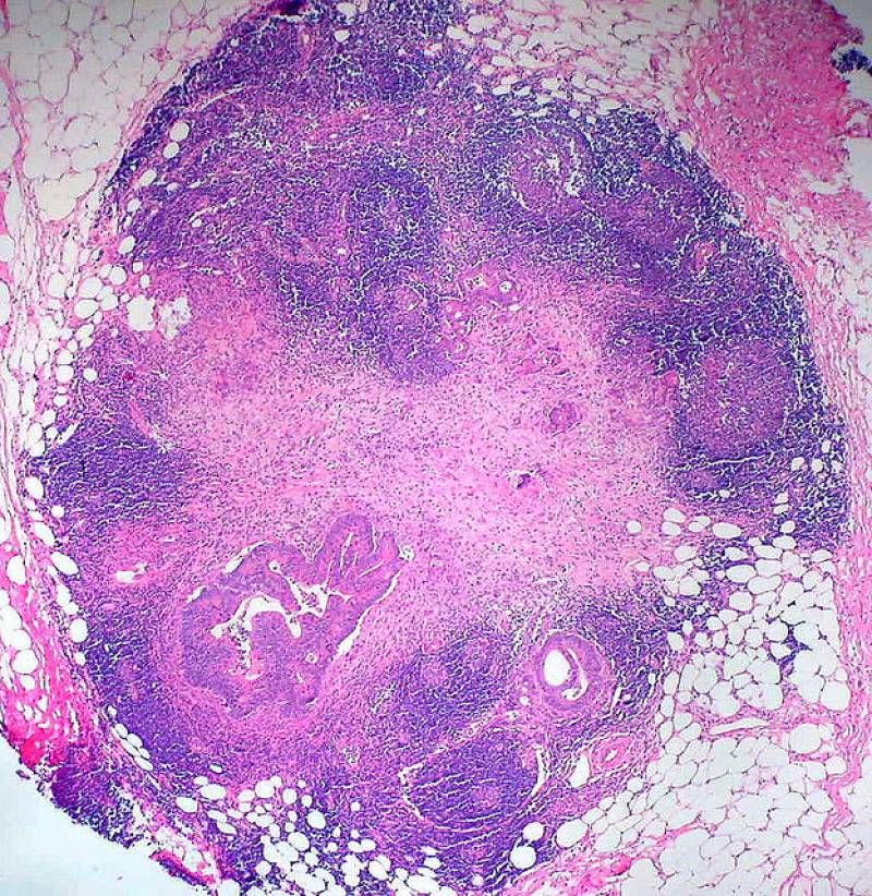 Células tumorales del colon: Imagen: E. Uthman  