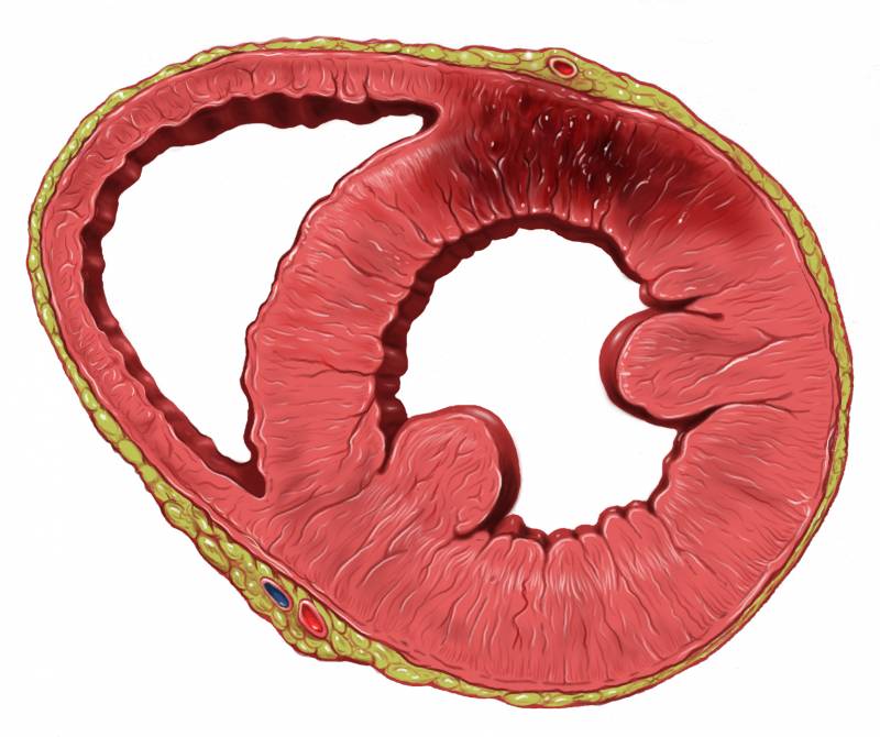 En la foto se observa un infarto en la pared anterior del corazón. Imagen: Wikipedia. 