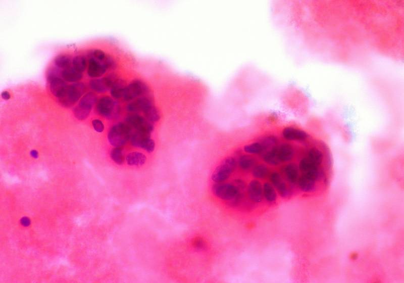 Células de cáncer de mama al microscopio. Imagen: euthman 