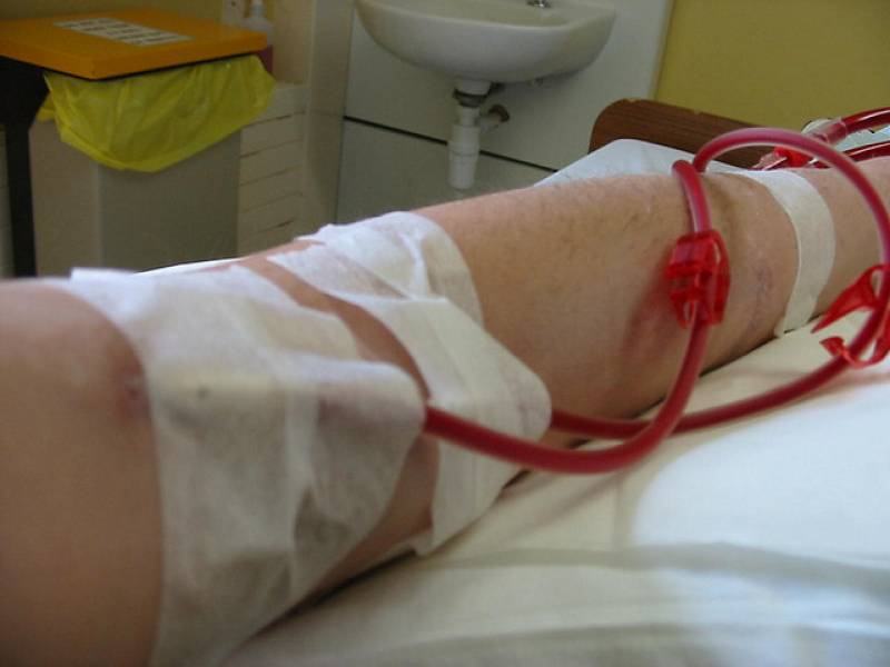 La diálisis sustituye la actividad de los riñones cuando ya no pueden eliminar las sustancias tóxicas que transporta la sangre. Imagen: Newslighter. 