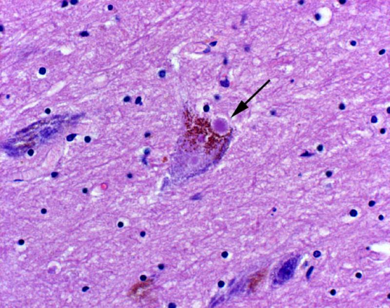 Neurona con cuerpos de Lewy