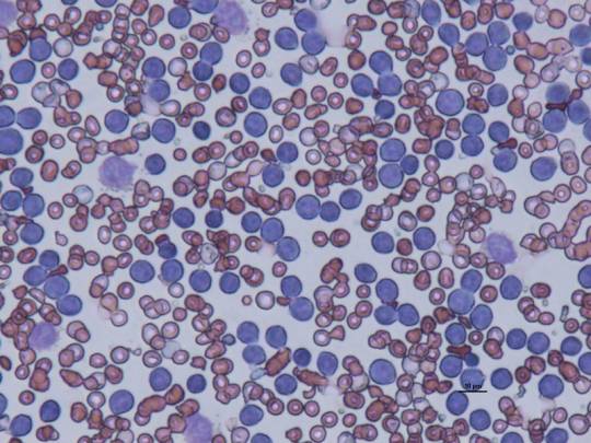 Imagen microscópica de un frotis de leucemia. / CSIC
