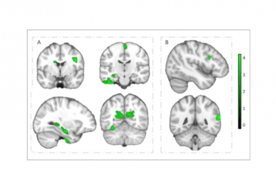 Los niños con mayor capacidad aeróbica tienen más materia gris Los ninos con mayor capacidad aerobica tienen mas materia gris en el cerebro image 380