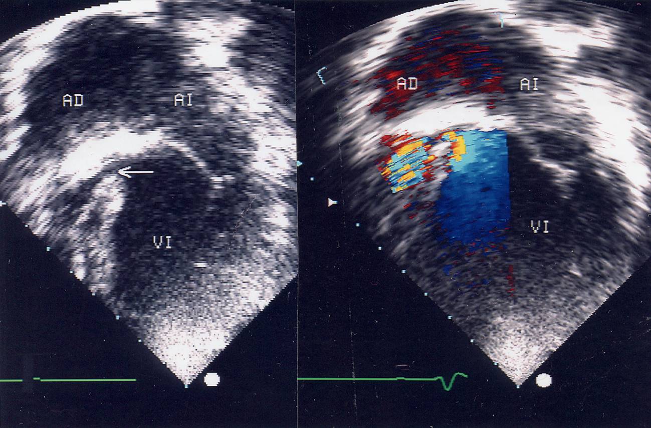 En la imagen, un corazón afectado de cardiopatía atresia tricúspide.