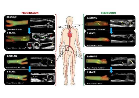 Casos de progresión de aterosclerosis (izquierda) y de regresión (desaparición de la misma, derecha)  en arterias carótidas (en el cuello) en las femorales (ingles). / CNIC