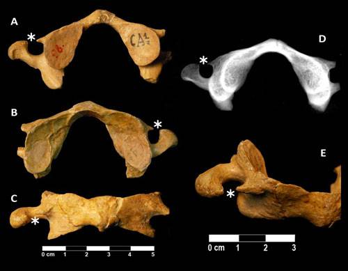 Atlas (Kr.98) recuperado del yacimiento de Krapina que presenta la variante anatómica conocida como Unclosed Transverse Foramen / Carlos A. Palancar et al.