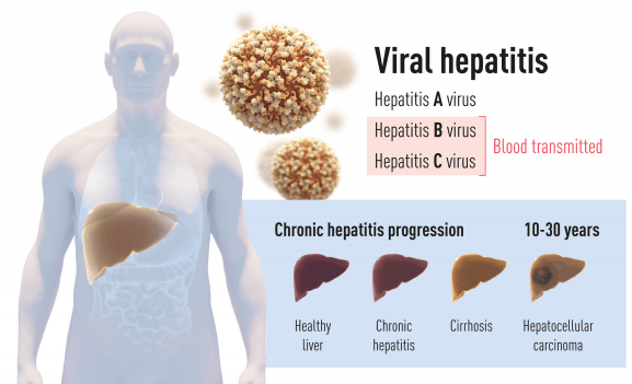 tipos de hepatitis