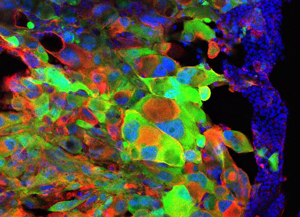 Muestra de un cerebro de ratón con glioma (verde). Imagen: Eric Bushong. 