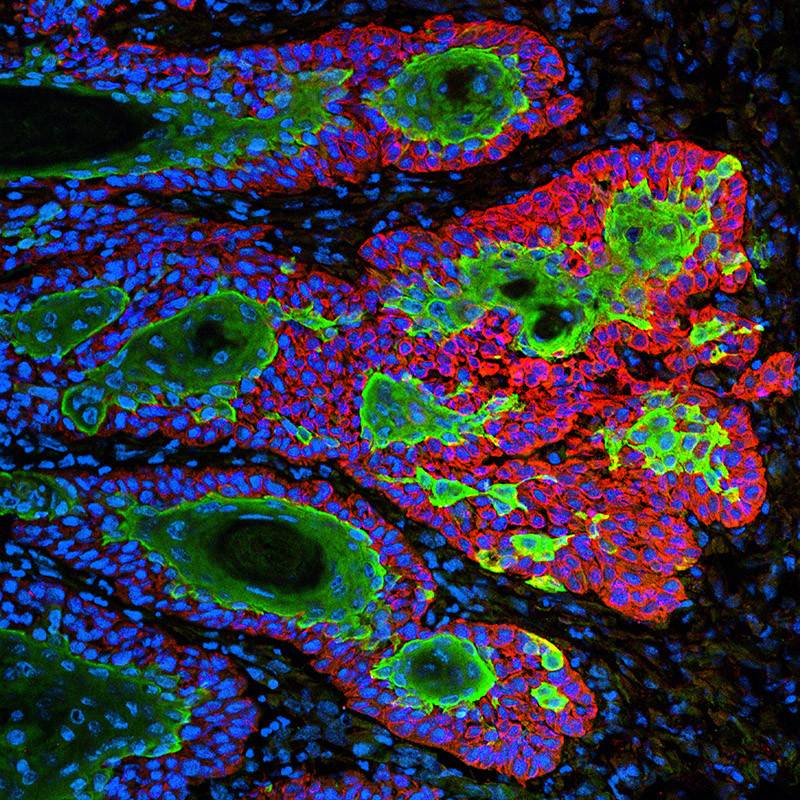 Carcinoma de células escamosas, un tipo muy común de cáncer de piel. / Markus Schober and Elaine Fuchs, The Rockefeller University.