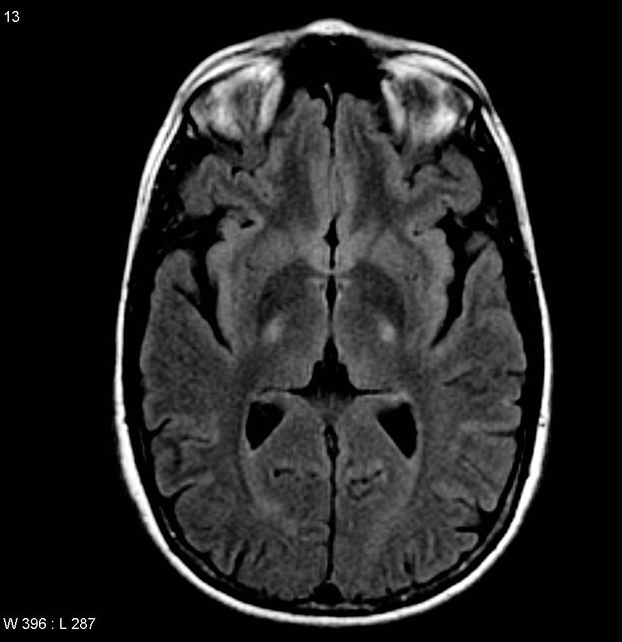 Cerebro afectado por ELA. Imagen: Wikipedia