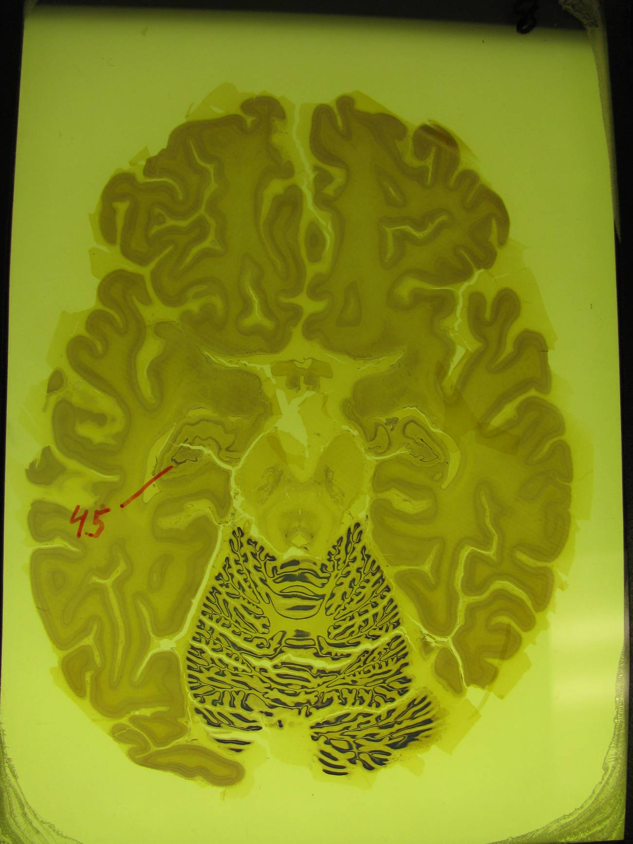 Una reducción del hipocampo en el cerebro precede al mal de Alzheimer