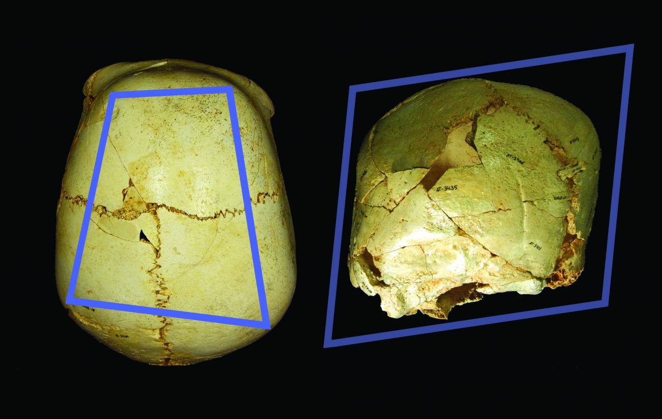 Investigadores del equipo de Atapuerca descubren un cráneo con una rara enfermedad congénita