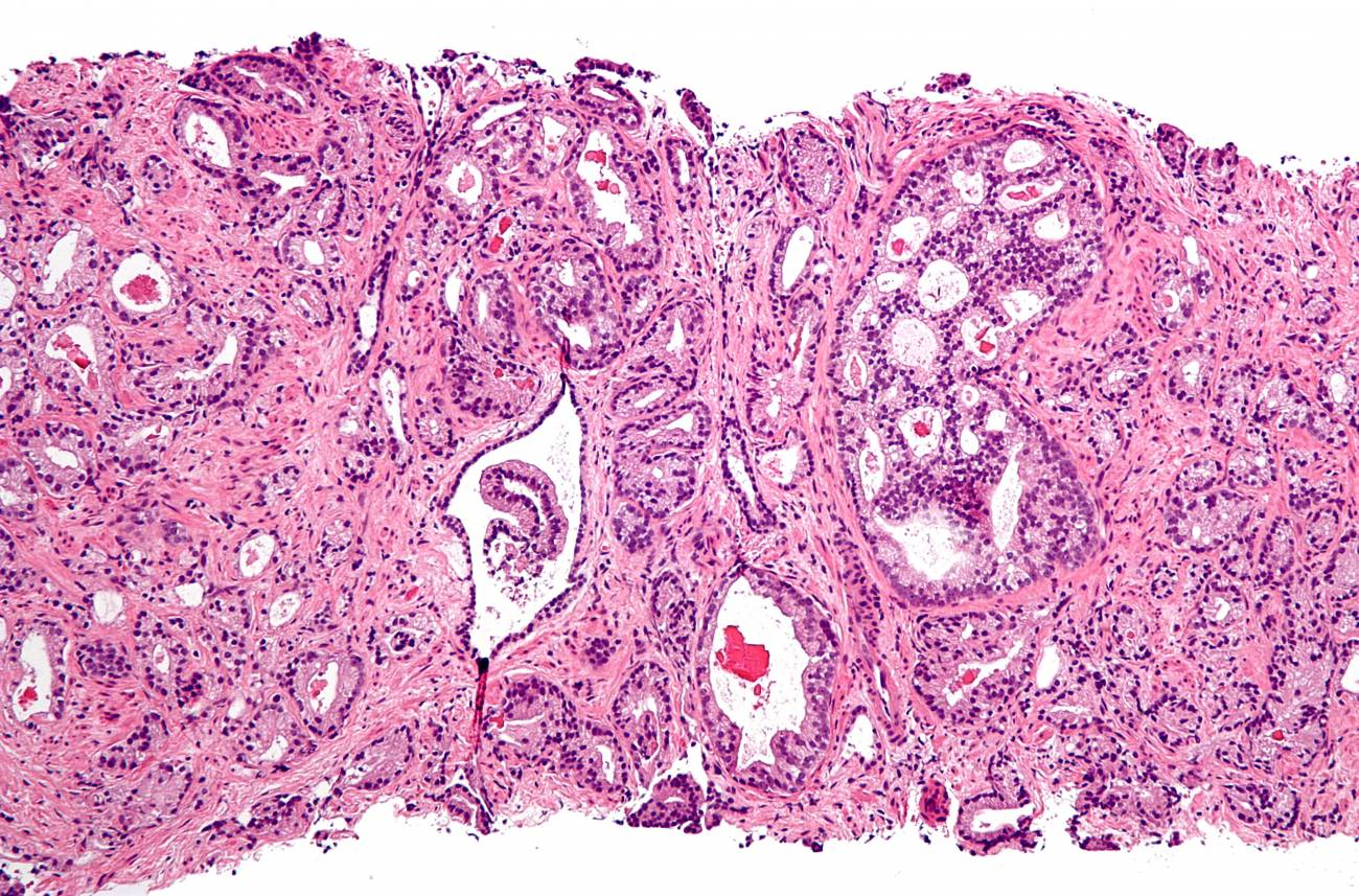 Células tumorales de próstata al microscopio. Imagen: Wikipedia