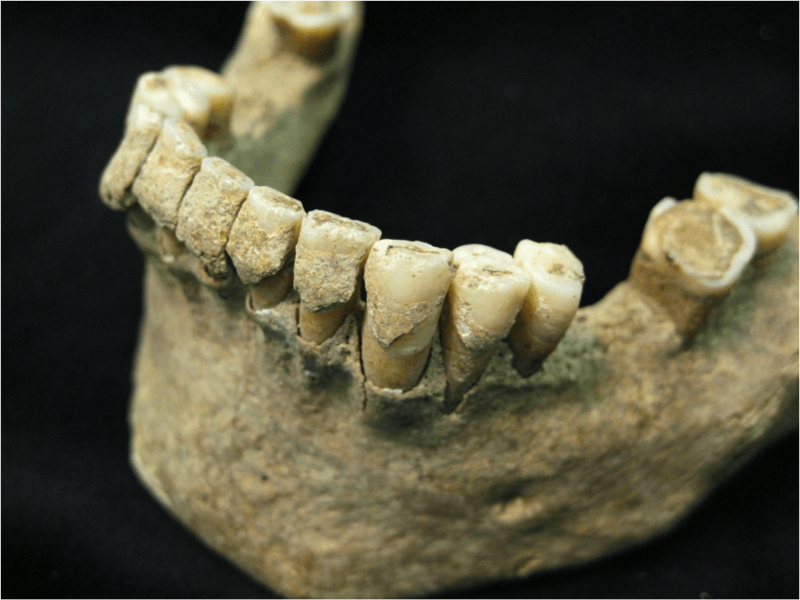 Placa dental mineralizada en la dentadura de un hombre de mediana edad del yacimiento medieval de Dalheim, del 1100 DC. / Christina Warinner.