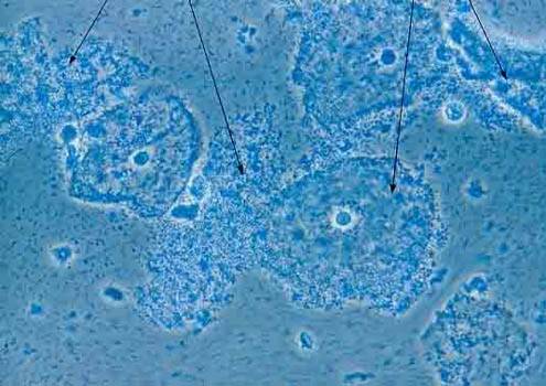 Micrografía de vaginosis bacterial. Imagen: Wikipedia 