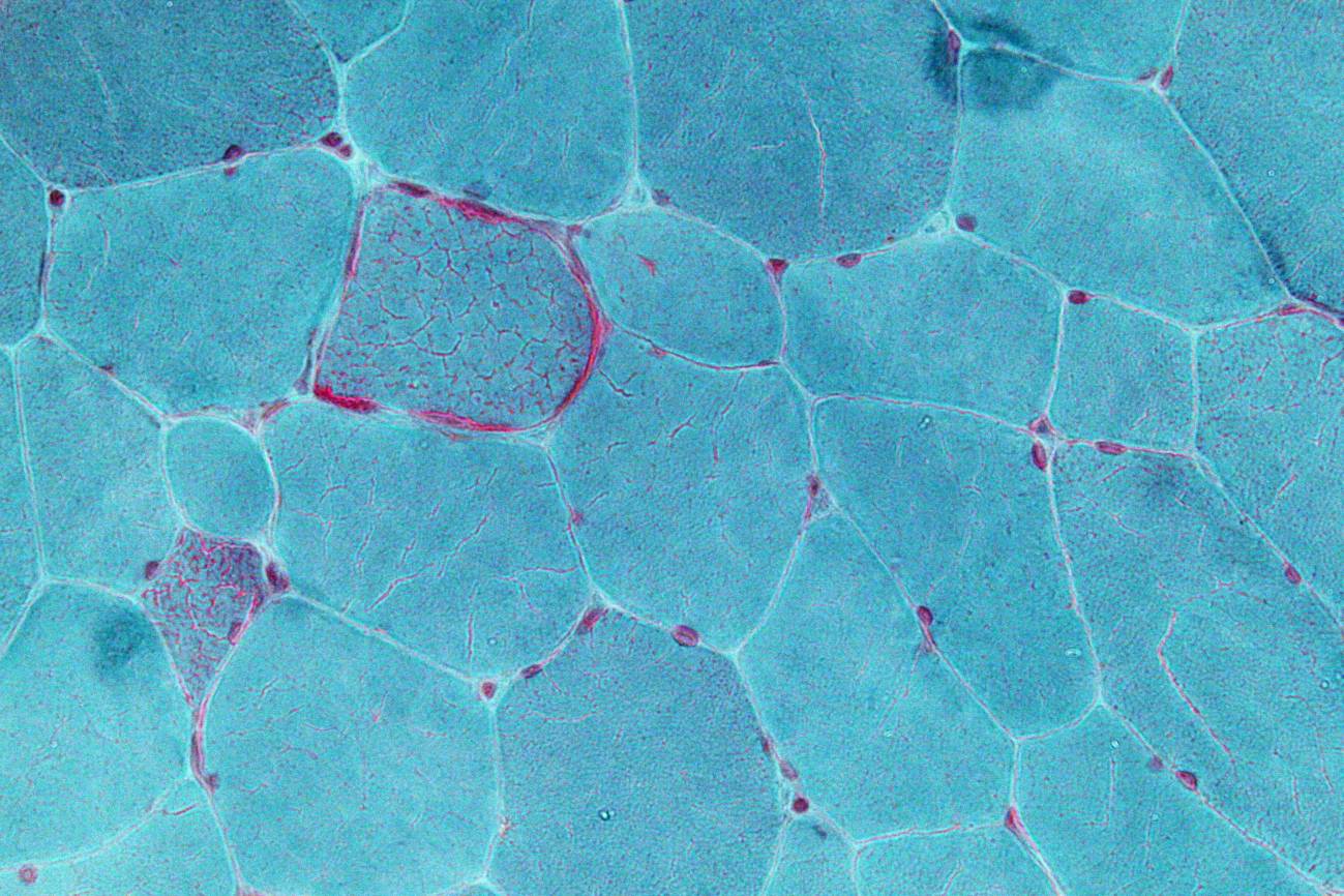 Micrografía que muestra fibras rojas rotas, un signo de algunas enfermedades mitocondriales. Imagen: Wikipedia