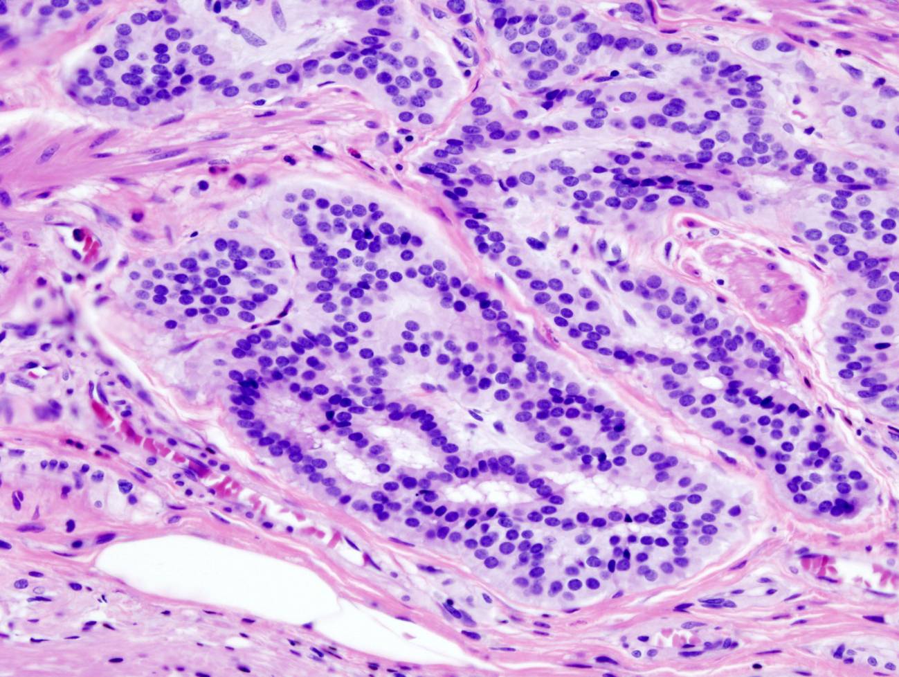 Imagen histopatológica de carcinoide de colon teñido con hematoxilina y eosina. Imagen:Wikipedia 