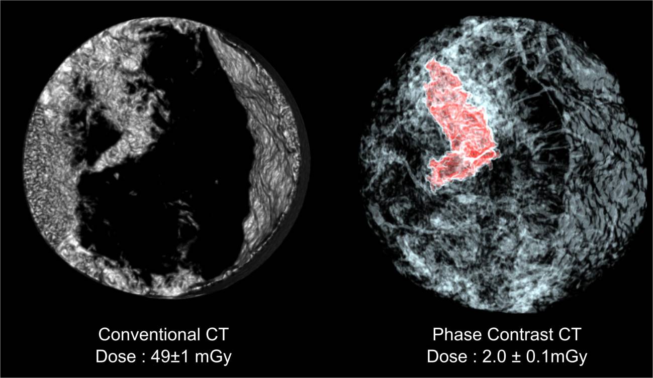 La TC puede reducir los riesgos asociados a las mamografías. Imagen: ESRF-LMU 