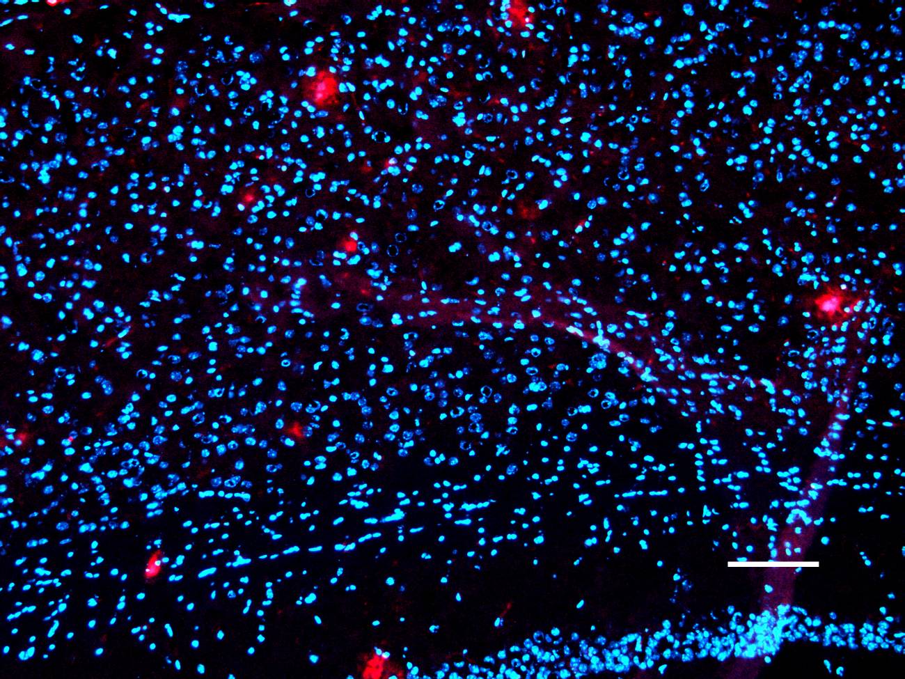 La imagen muestra la corteza de un ratón APP/PS1 de seis meses tratado con bexaroteno. Los investigadores utilizaron anti amiloideo beta (6E10: rojo) para marcar las placas centrales difusas y densas encontradas en la corteza.