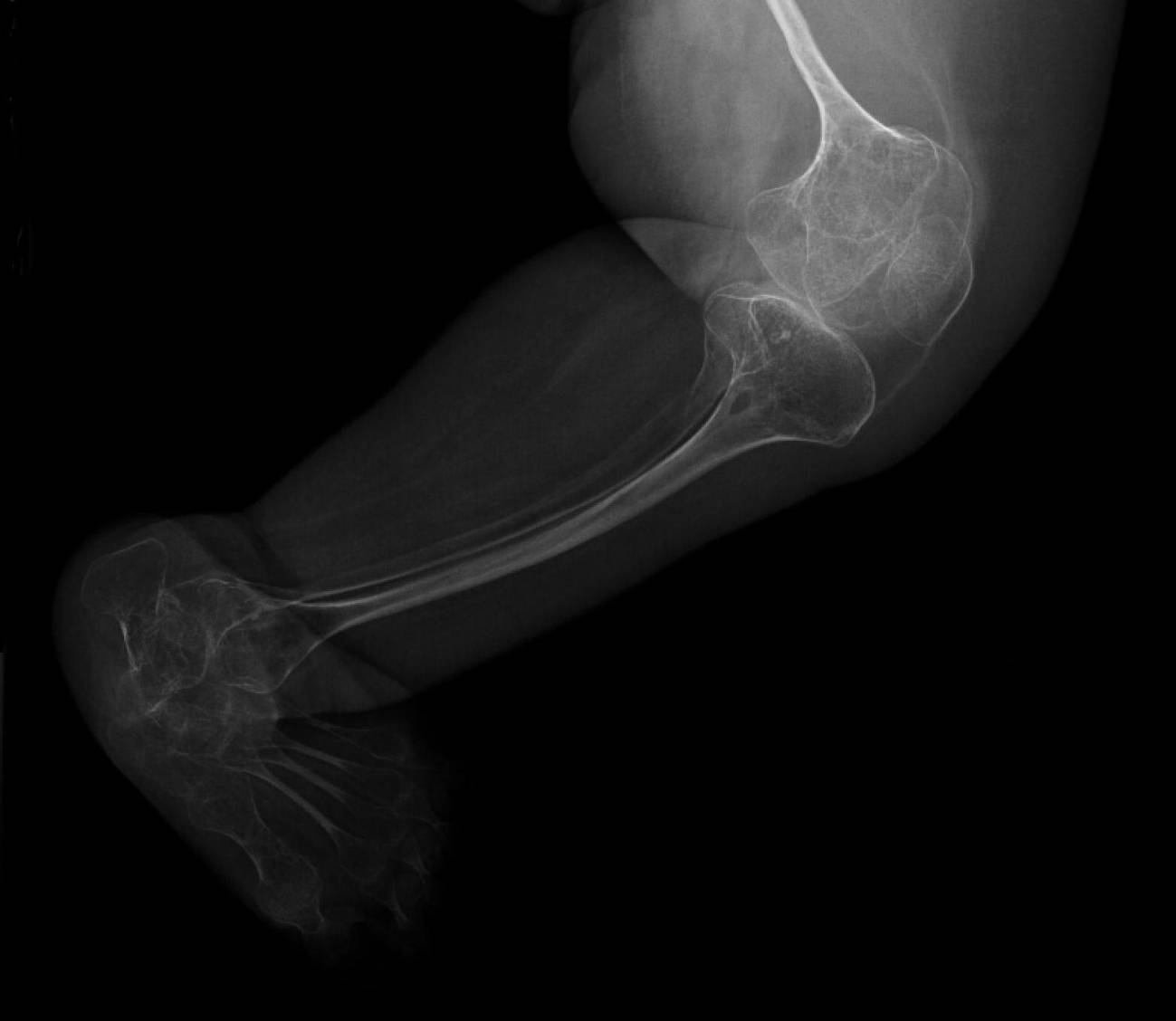 Radiografía de un paciente con osteogénesis imperfecta. Imagen: Hospital Universitario La Paz.