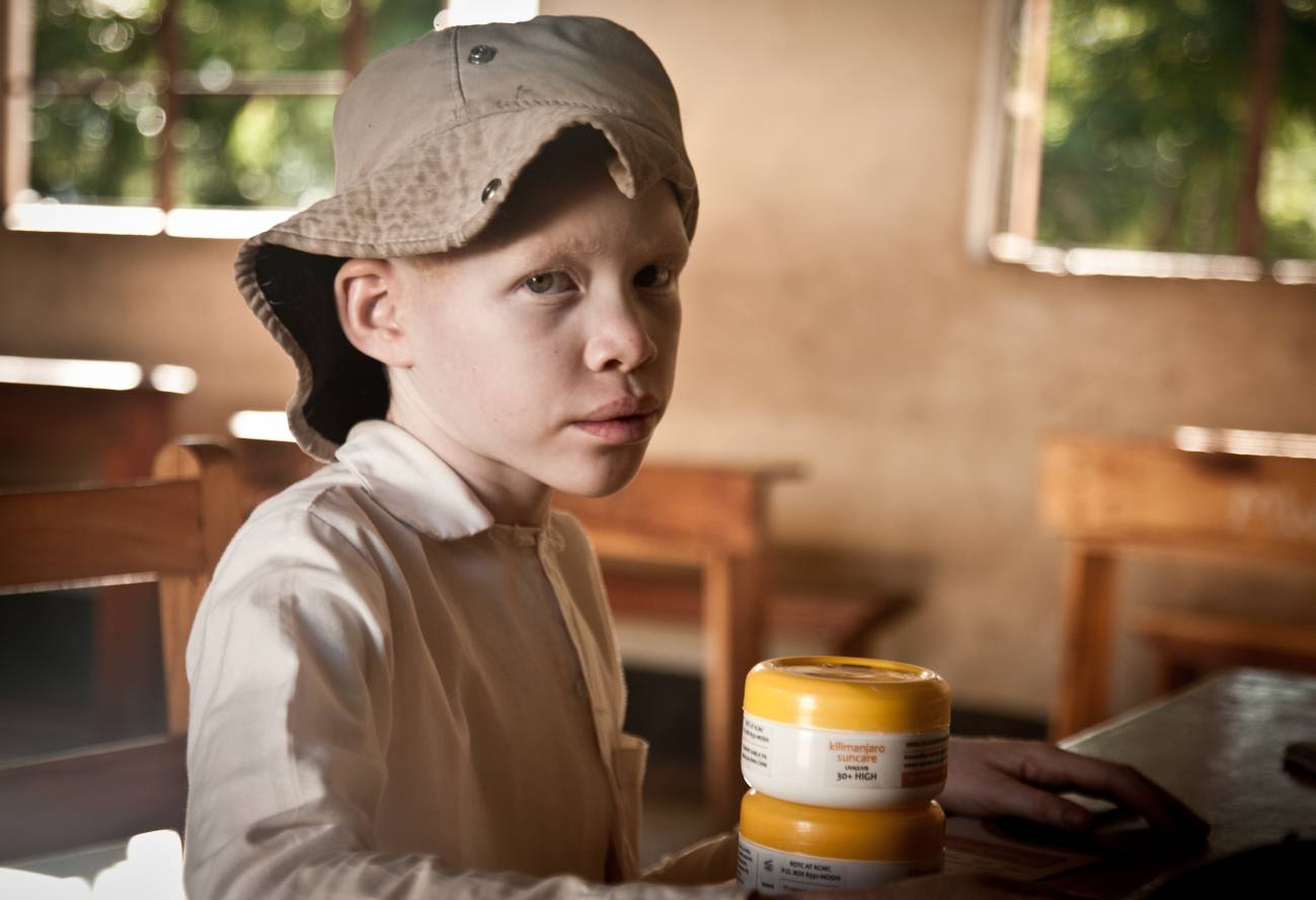 Un niño con albinismo con la crema Kilimanjaro Suncare. / Daniel Losada