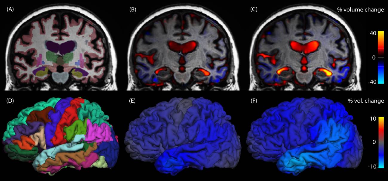 Analizan los cambios estructurales del cerebro en la enfermedad de Alzheimer