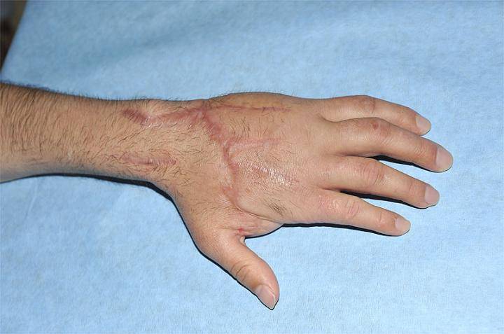Médicos españoles reconstruyen la mano izquierda de un hombre con dedos de la derecha