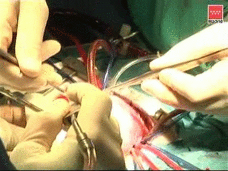 Implantan un corazón artificial a un bebé