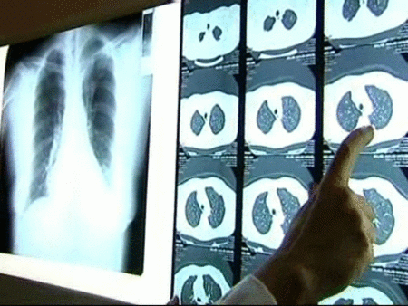 Los pacientes fumadores son los más propensos a padecer nódulos pulmonares