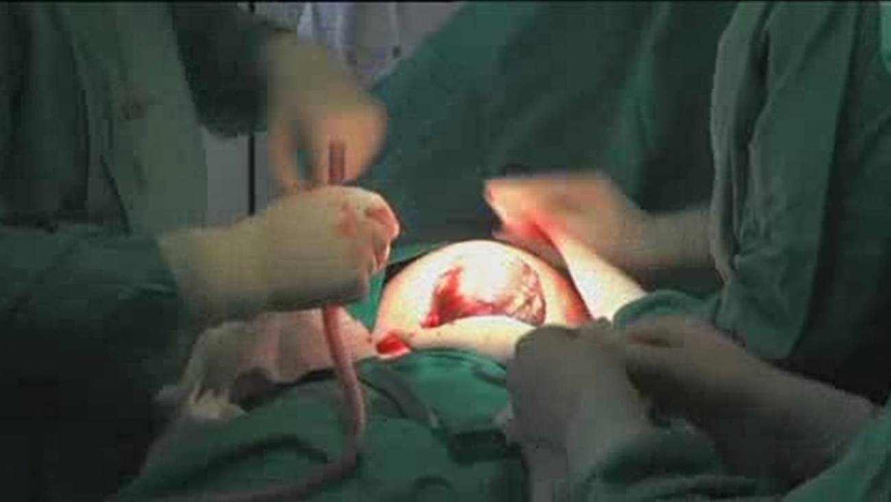 Médicos de La Paz colocan un marcapasos a un bebé 