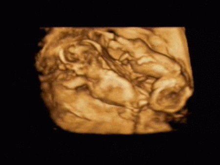 Primer embarazo en España tras un trasplante de tejido ovárico