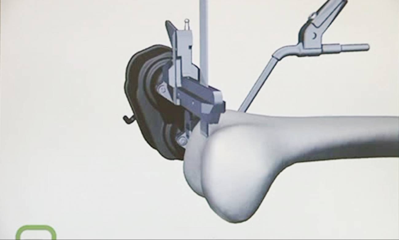Primera operación de rodilla en España con un brazo robótico