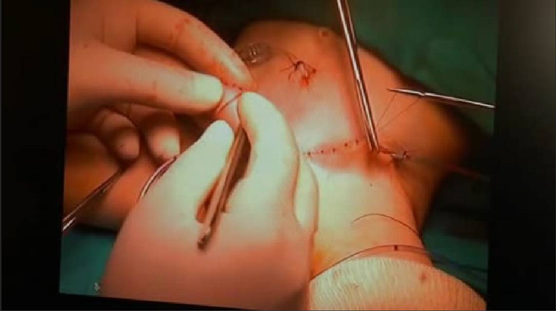 Una técnica pionera en España permite reconstruir el pene de un bebé 