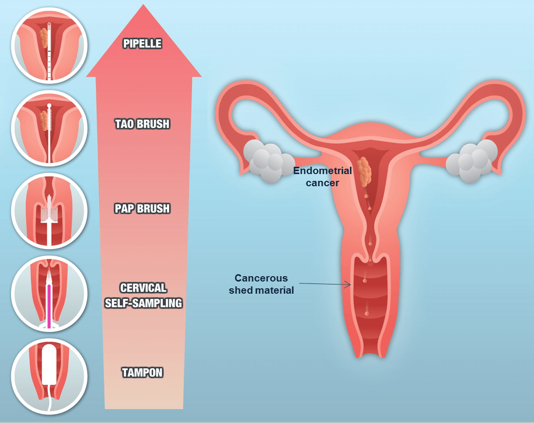Tipos de muestreos en cáncer de endometrio