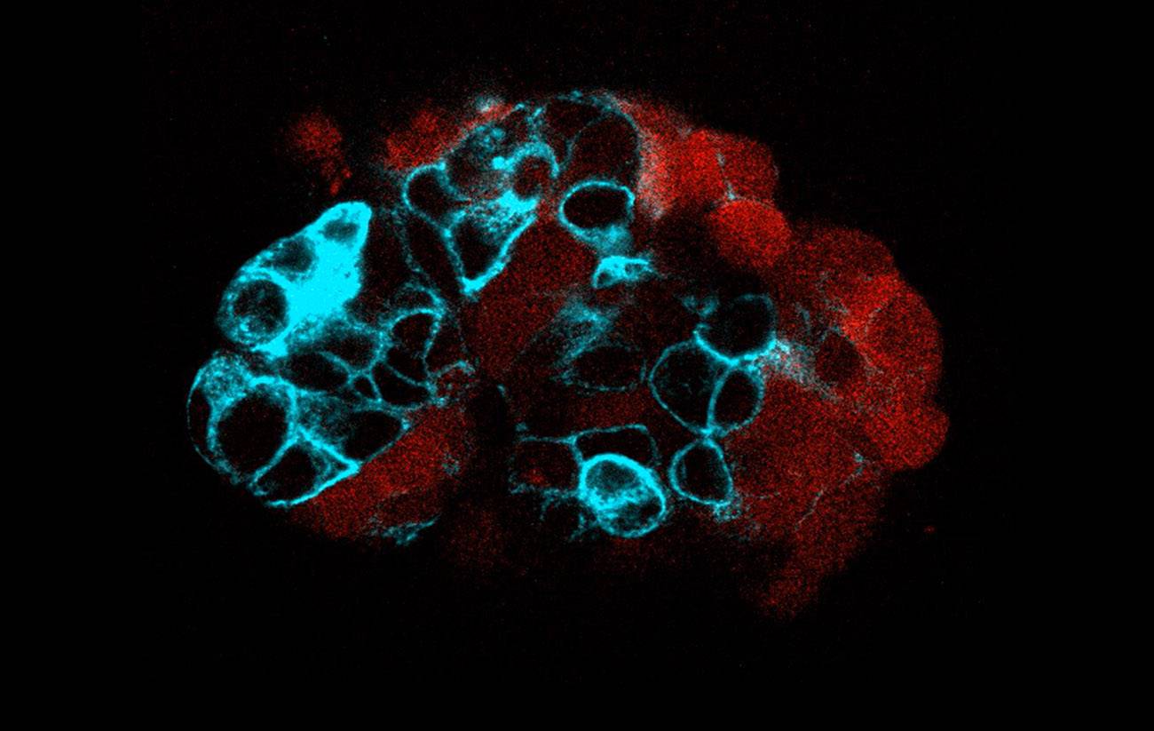 Cómo la física de las células de cáncer colorrectal contribuye a la metástasis