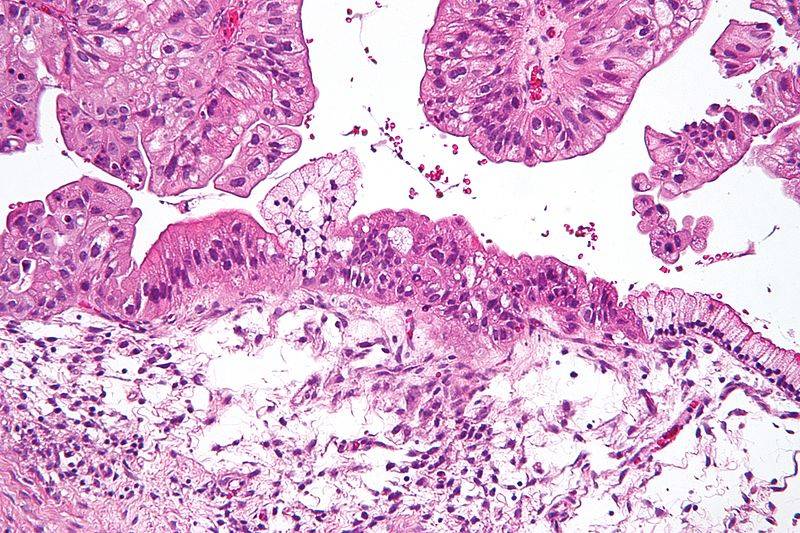 células cancerosas de ovario