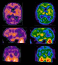 Cerebro afectado por enfermedad de Parkinson