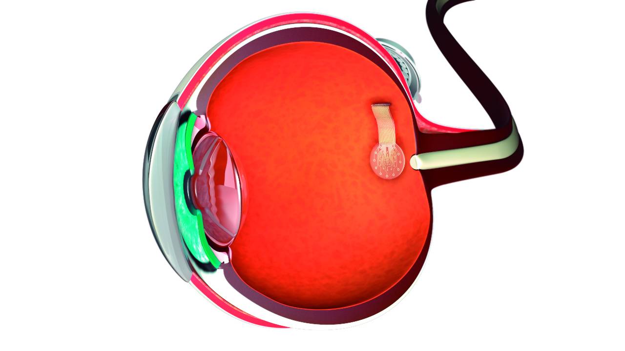 Prótesis de retina con estimuladores de grafeno