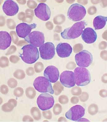 Frote sanguíneo que muestra linfocitos (morados) en una LLA. Imagen: Wikipedia