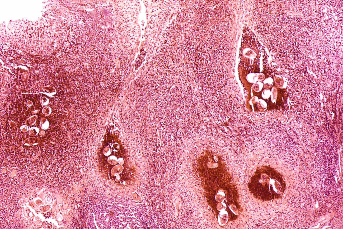 Fotomicrografía de una vejiga infectada por S. haematobium. / Wikipedia