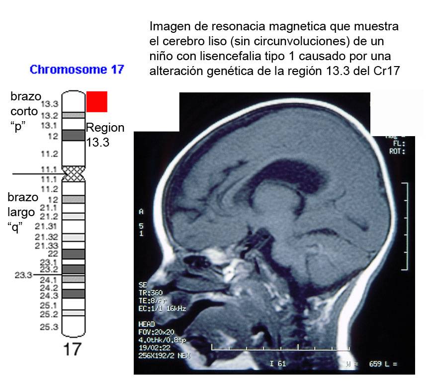 Imagen de resonancia magenética que muestra el cerebro liso (sin circunvalaciones) de un niño con lisencefalia tipo 1 causada por una alteración del cromosoma 17