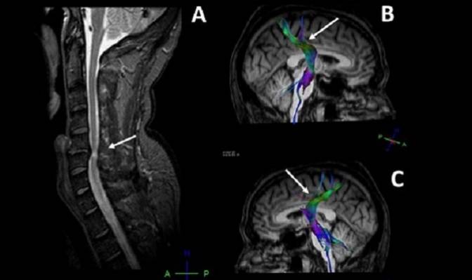 Detectan daño cerebral en pacientes con hernias cervicales