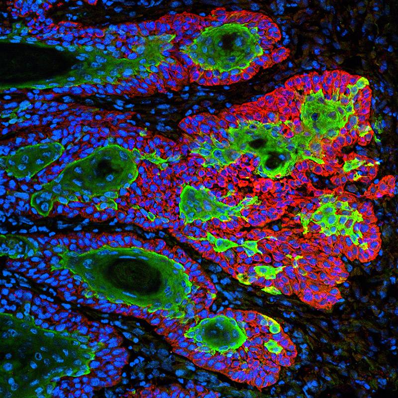 Carcinoma de células escamosas, un tipo muy común de cáncer de piel / Markus Schober and Elaine Fuchs, The Rockefeller University.