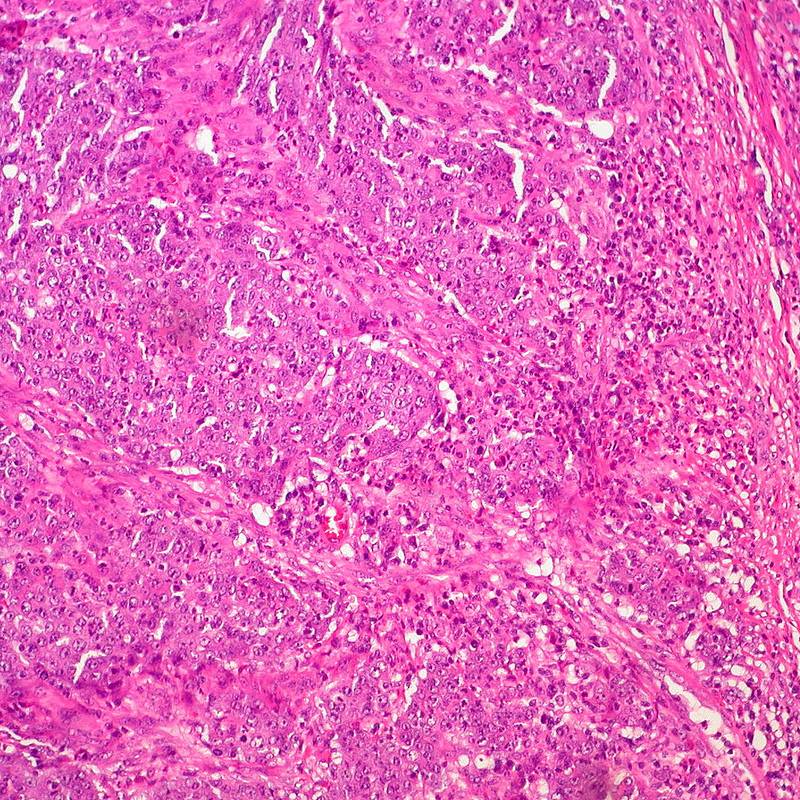 Muestra de un carcinoma medular de colon / Ed Uthman.