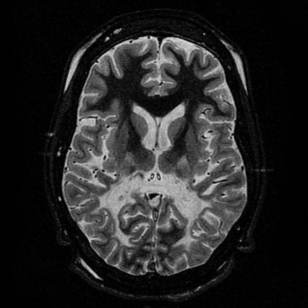 Escáner del cerebro de un paciente con adrenoleucodistrofia. / Wikipedia