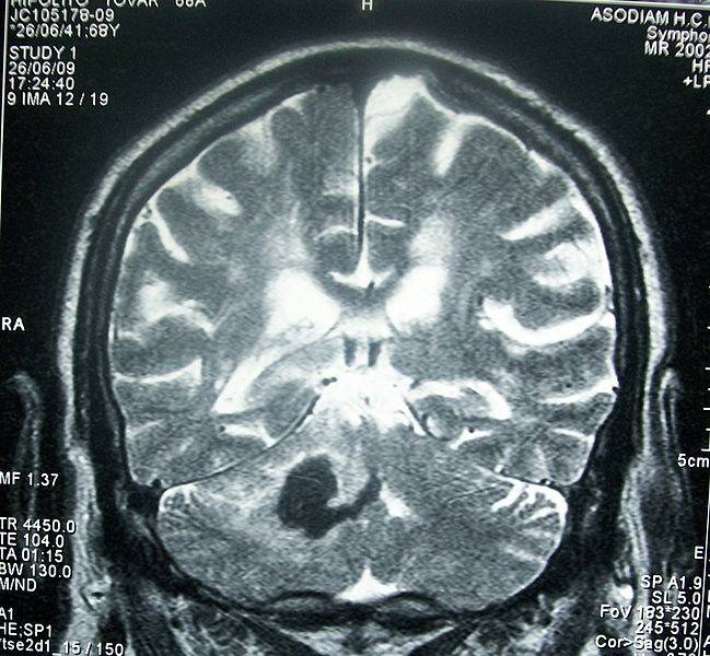 RMN de cráneo mostrando hemorragia intracerebral profunda (cerebelo). Imagen: Wikipedia