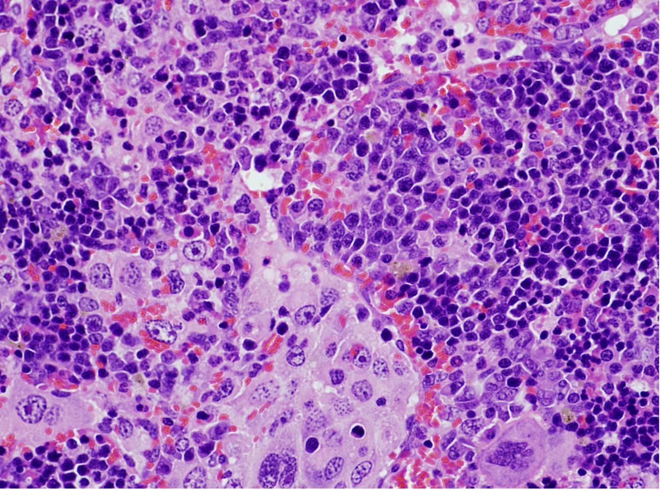 Imagen de microscopía de un bazo que presenta un linfoma desarrollado por ratones que expresan una mutación oncogénica en el gen VAV1. / Xosé R. Bustelo