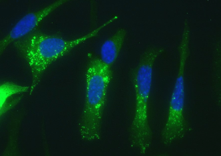 Células de adenocarcinoma pancreático humano